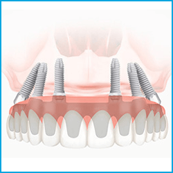 протезирование зубов All-on-6